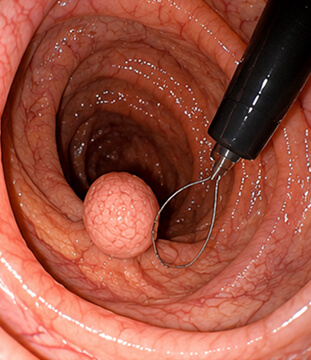 Colonoscopia