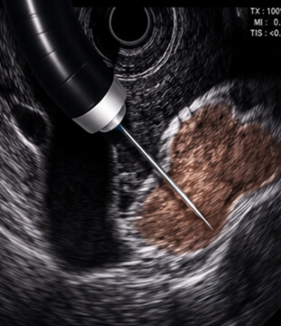 Ecoendoscopia